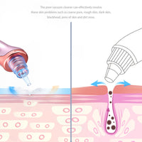 Blackhead Remover Tool